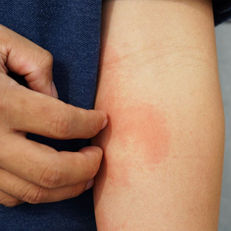 Avaderma Skin & Hair Clinic - Urticaria (Hives)